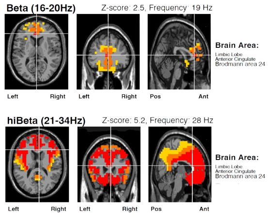 qEEG sLORETA source imaging visualisation
